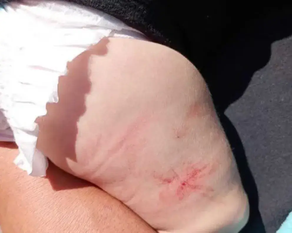 El pequeño fue internado en el Hospital Mi Pueblo, donde actualmente recibe tratamiento médico debido a signos de infección y complicaciones derivadas del incidente.